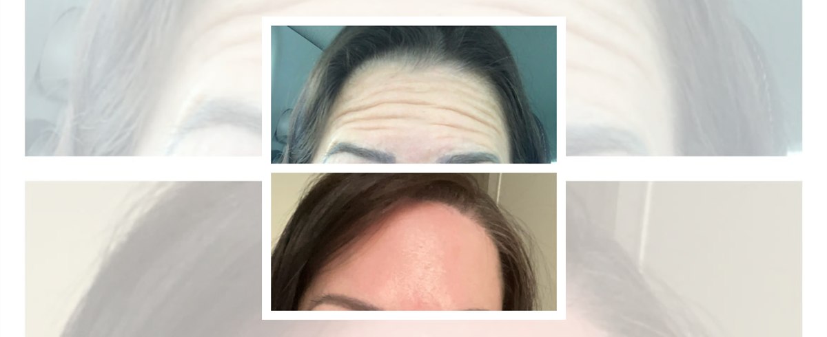 Botox antirynkbehandling panna före och efter